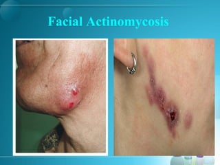 Facial Actinomycosis
 
