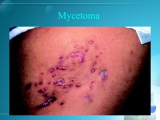 Mycetoma
 