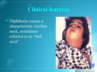 Clinical features
 Diphtheria causes a
characteristic swollen
neck, sometimes
referred to as “bull
neck” .
 