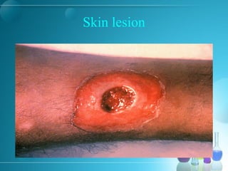 Skin lesion
 