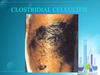CLOSTRIDIAL CELLULITIS
 