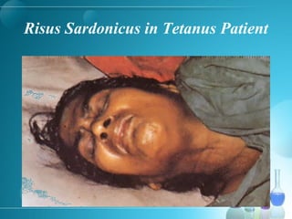 Risus Sardonicus in Tetanus Patient
 