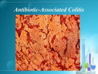 Antibiotic-Associated Colitis
 
