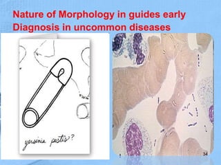 Nature of Morphology in guides early
Diagnosis in uncommon diseases
34
 