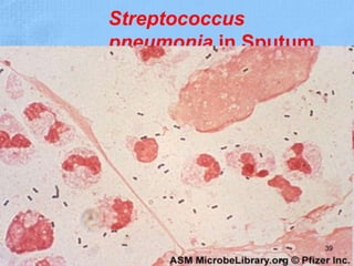 Streptococcus
pneumonia in Sputum
39
 
