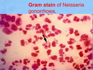 Gram stain of Neisseria
gonorrhoea,
40
 