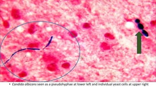 • Candida albicans seen as a pseudohyphae at lower left and individual yeast cells at upper right
 