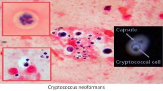 Cryptococcus neoformans
 