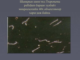 Шанкрын шингэнд Treponema
   pallidum бараан талбайт
микроскопийн 40х объективоор
        харагдаж байна.
 
