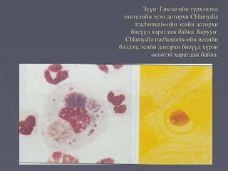 Зүүн: Гимзагийн түрхэцэнд
 эпителийн эсэн доторхи Chlamydia
     trachomatis-ийн эсийн доторхи
    биеүүд харагдаж байна. Баруун:
  Chlamydia trachomatis-ийн иодийн
бэлдэц, эсийн доторхи биеүүд хүрэн
            өнгөтэй харагдаж байна.
 