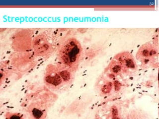 Streptococcus pneumonia
32
 