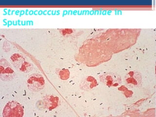 Streptococcus pneumoniae in
Sputum
 
