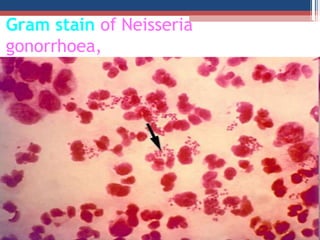 Gram stain of Neisseria
gonorrhoea,
 