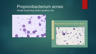 Propionibacterium acnes
Small branching Gram positive rod
 