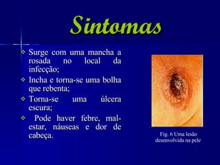 Sintomas Surge com uma mancha a rosada no local da infecção; Incha e torna-se uma bolha que rebenta; Torna-se uma úlcera escura; Pode haver febre, mal-estar, náuseas e dor de cabeça.  Fig. 6 Uma lesão desenvolvida na pele   