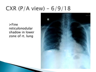 Fine
reticulonodular
shadow in lower
zone of rt. lung
 