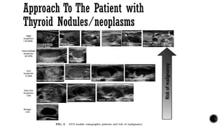 Approach To The Patient with
Thyroid Nodules/neoplasms
 
