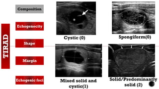 TIRAD Composition
Echogenecity
Shape
Margin
Echogenic foci
Spongiform(0)Cystic (0)
Mixed solid and
cystic(1)
Solid/Predominantly
solid (2)
 
