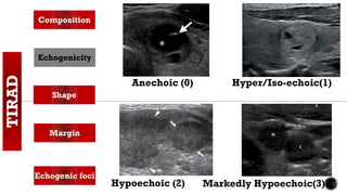 TIRAD Composition
Echogenicity
Shape
Margin
Echogenic foci
Anechoic (0)
Hypoechoic (2)
Hyper/Iso-echoic(1)
Markedly Hypoechoic(3)
 