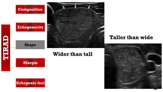 TIRAD Composition
Echogenecity
Shape
Margin
Echogenic foci
Wider than tall
Taller than wide
 