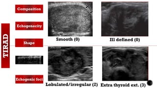 TIRAD Composition
Echogenecity
Shape
Margin
Echogenic foci
Smooth (0) Ill defined (0)
Extra thyroid ext. (3)Lobulated/irregular (2)
 