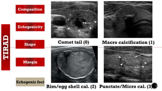 TIRAD Composition
Echogenicity
Shape
Margin
Echogenic foci
Comet tail (0)
Punctate/Micro cal. (3)
Macro calcification (1)
Rim/egg shell cal. (2)
 