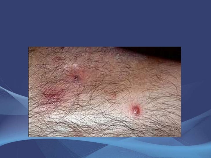 HOT TUB FOLLICULITIS.ppt