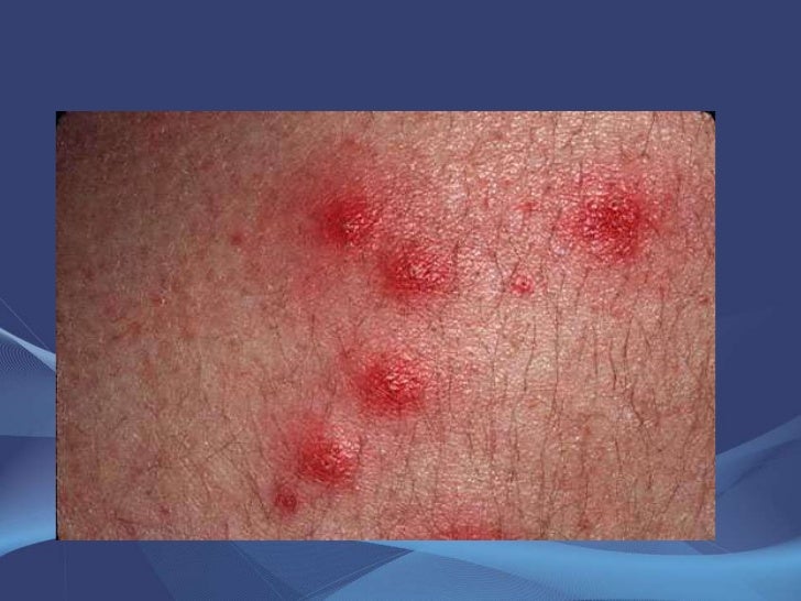 HOT TUB FOLLICULITIS.ppt