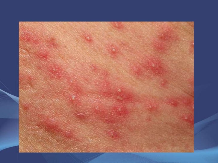 HOT TUB FOLLICULITIS.ppt