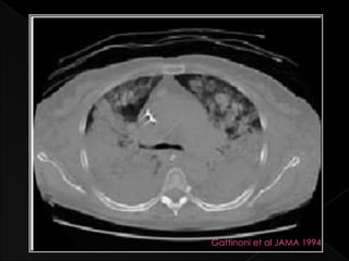 Gattinoni et al JAMA 1994
 