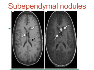 Subependymal nodules
 