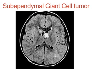Subependymal Giant Cell tumor
 
