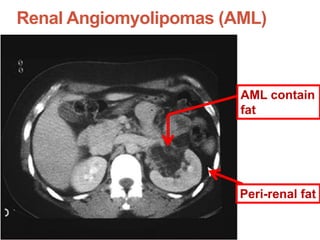 Renal Angiomyolipomas (AML)
AML contain
fat
Peri-renal fat
 