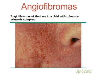 Angiofibromas
 