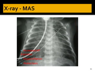 61
 IncreasedAP
diameter
 Hyperinflation
 Atelectasis
 