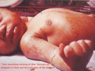 Note meconium staining of skin Increase AP
diameter of chest and the convexity of the sternum
 