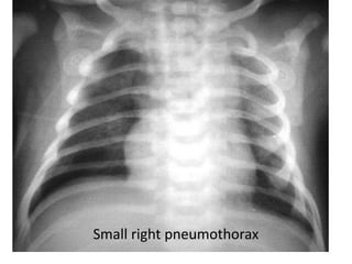 Small right pneumothorax
 