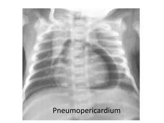 Pneumopericardium
 