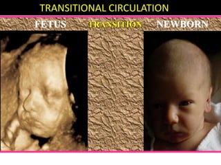 FETUS TRANSITION NEWBORN
TRANSITIONAL CIRCULATION
 