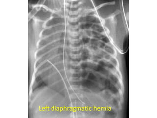 Left diaphragmatic hernia
 