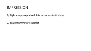 IMPRESSION
1/ Right eye preseptal cellulitis secondary to tick bite
2/ bilateral immature cataract
 
