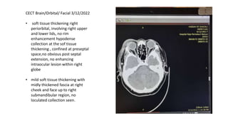 CECT Brain/Orbital/ Facial 3/12/2022
• soft tissue thickening right
periorbital, involving right upper
and lower lids, no rim
enhancement hypodense
collection at the sof tissue
thickening , confined at preseptal
space,no obvious post septal
extension, no enhancing
intraocular lesion within right
globe
• mild soft tissue thickening with
midly thickened fascia at right
cheek and face up to right
submandibular region, no
loculated collection seen.
 