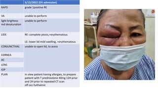 5/12/2022 (D5 admission)
RAPD grade 1positive RE
VA unable to perform
light brightess
red desaturation
unable to perform
LIDS RE: complete ptosis,+erythematous
LE: lower lid mild swelling, +erythematous
CONJUNCTIVAL unable to open lid, to acess
CORNEA
AC
LENS
IOP
PLAN in view patient having allergies, to prepare
patient with T prednisolone 40mg 12H prior
and 2H prior to repeated CT scan
off occ fuithalmic
 