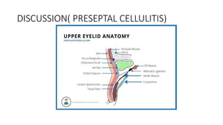DISCUSSION( PRESEPTAL CELLULITIS)
 