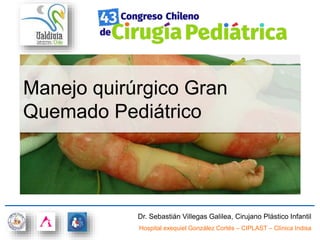 Dr. Sebastián Villegas Galilea, Cirujano Plástico Infantil
Hospital exequiel González Cortés – CIPLAST – Clínica Indisa
Manejo quirúrgico Gran
Quemado Pediátrico
 