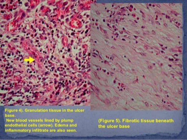 Granulation tissue formation