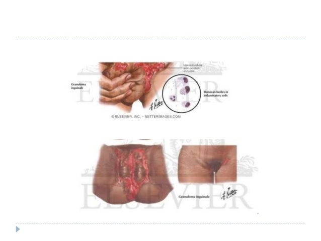 lymphogranuloma venereum