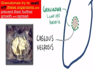Granulomas try to wall
off these organisms and
prevent their further
growth and spread.
 