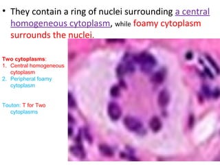• They contain a ring of nuclei surrounding a central
homogeneous cytoplasm, while foamy cytoplasm
surrounds the nuclei.
Two cytoplasms:
1. Central homogeneous
cytoplasm
2. Peripheral foamy
cytoplasm
Touton: T for Two
cytoplasms
 