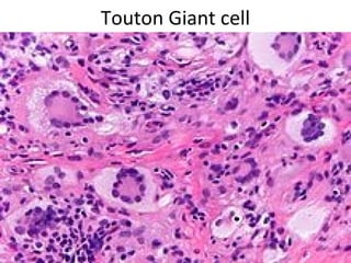 Touton Giant cell
 